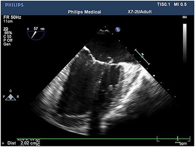 The Application of Transesophageal Echocardiography in Mitral Valve Repair With Tendon Reconstruction